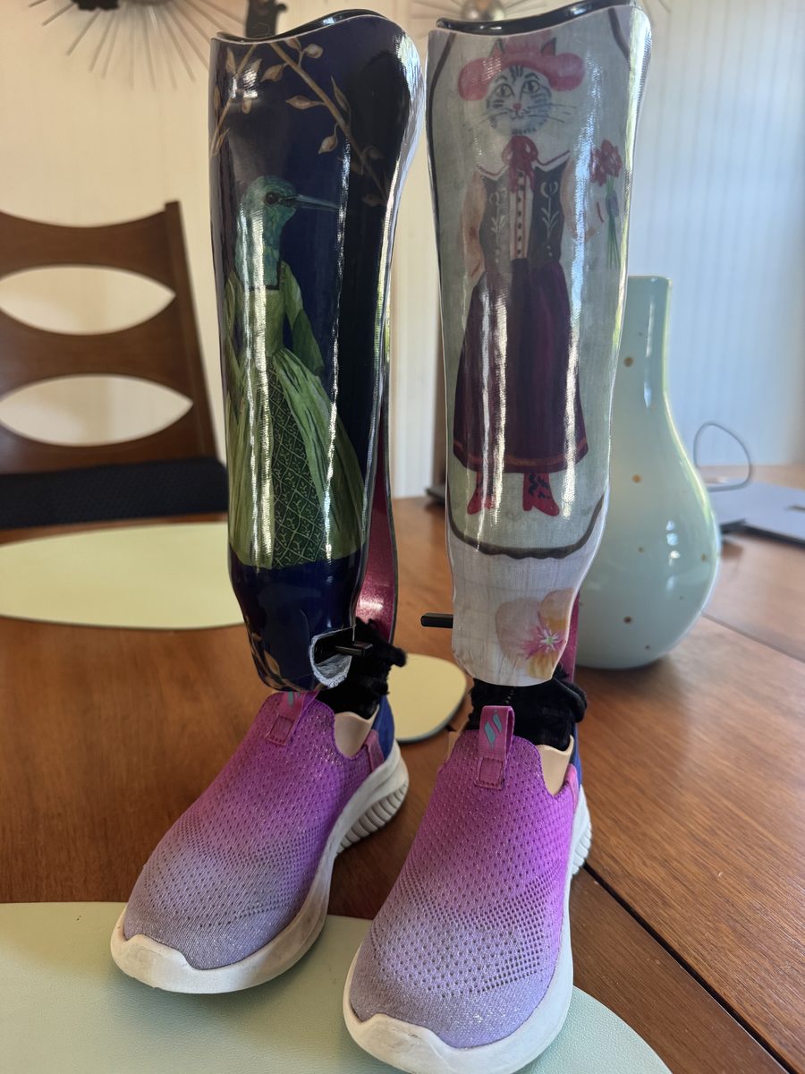 Front view of Gwen’s sixth set of prosthetics with fancy hummingbird and cat socket designs