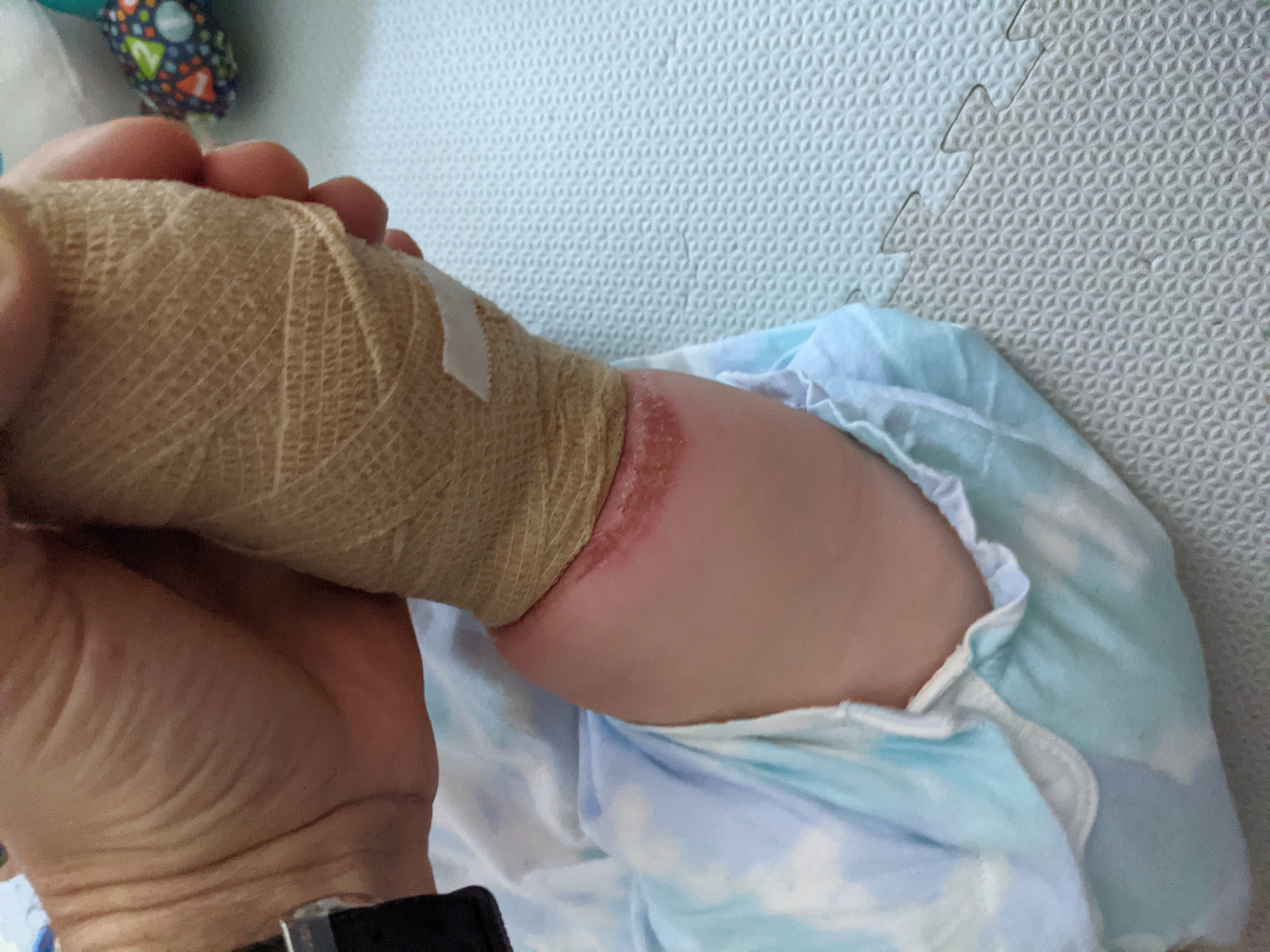 Skin complications from surgical bandages